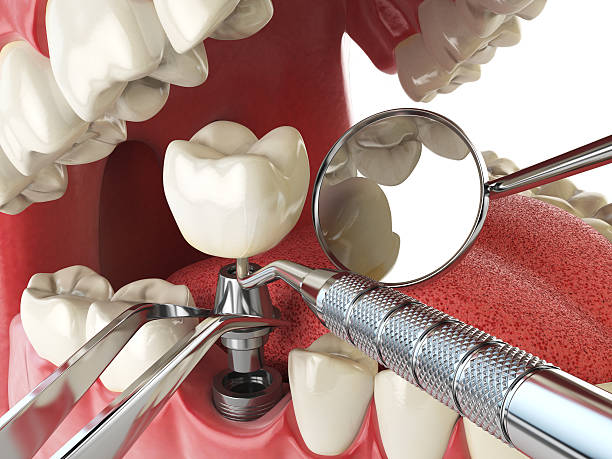Best Cracked Tooth Emergency Dentist  in Lake Forest, CA